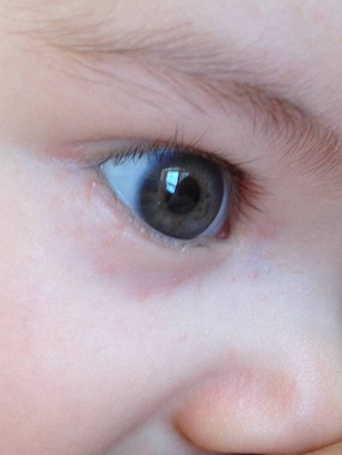 Сыпь вокруг глаз: белые и красные прыщики на веках у ребенка – что это может быть?