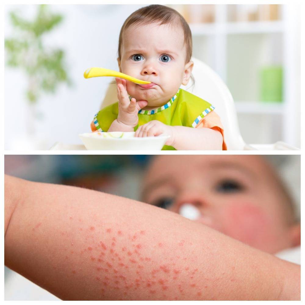 Аллергия у ребенка на лице — как выглядят высыпания