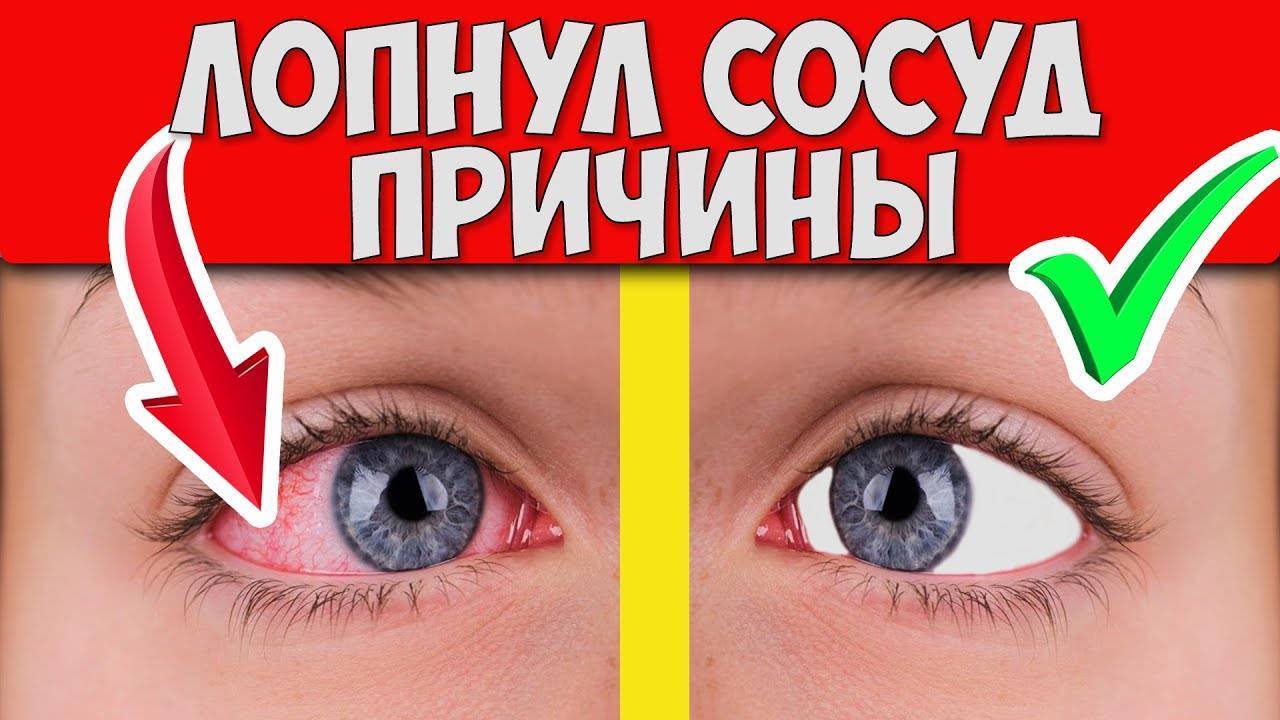 Почему лопаются сосуды: причины покраснения глаз