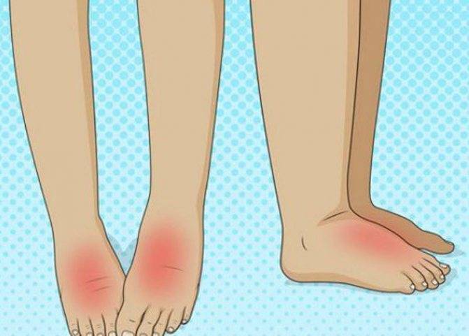 Экзема на ногах - эффективное лечение, причины и симптомы заболевания