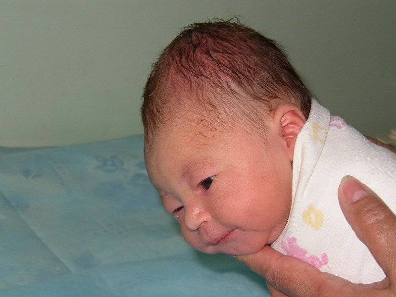 Кефалогематома на голове у новорожденного: лечение, последствия