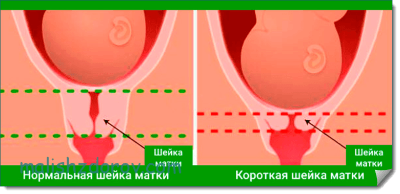 Как выглядит матка при беременности. Шейка матки при беременности. Нормальная шейка короткая шейка матки. Короткая шейка матки у беременных.