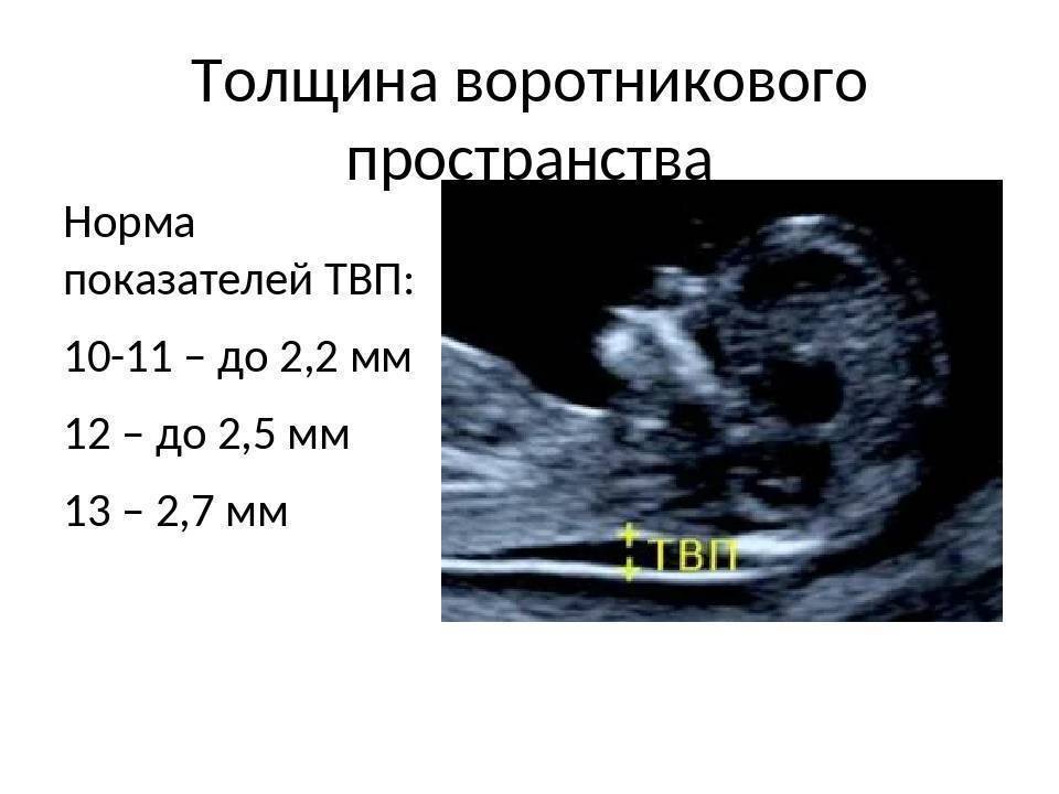 Толщина воротникового пространства -2,7 мм... - счастливая беременность - страна мам
