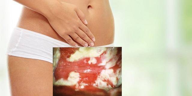 Варикозное расширение вен влагалища: варикоз вульвы во время беременности - блог мц аист