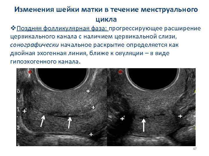 Реактивные изменения шейки