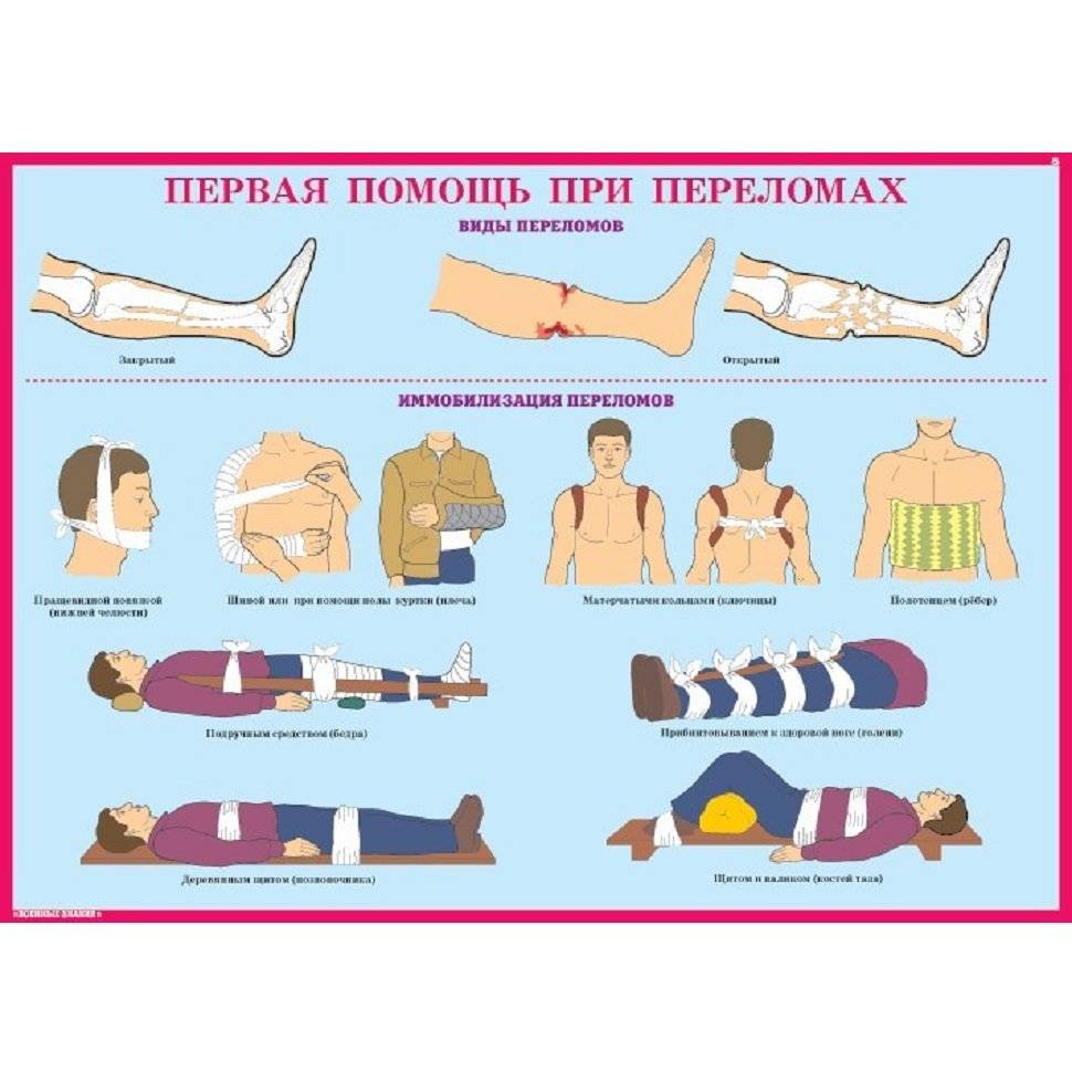 Первая помощь при переломе. что можно сделать до приезда «скорой»
