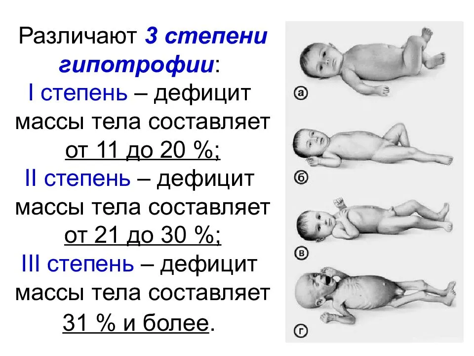 Гипотрофия у детей 1, 2 и 3 степени: причины и лечение / mama66.ru