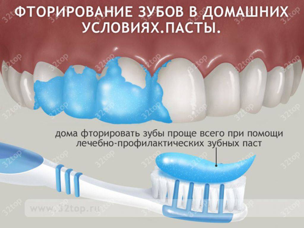 Фторирование зубов: все за и против