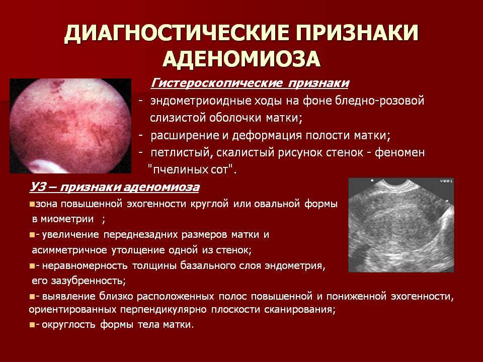 Аденомиоз матки и беременность: возможно ли забеременеть при этом заболевании?