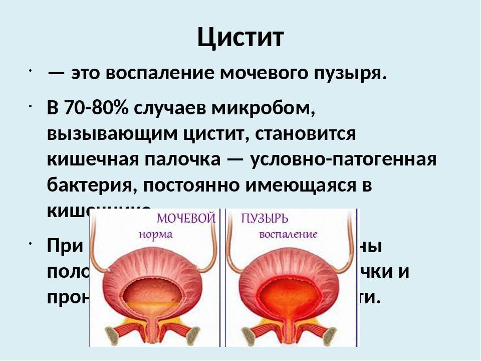 Презентация на тему цистит