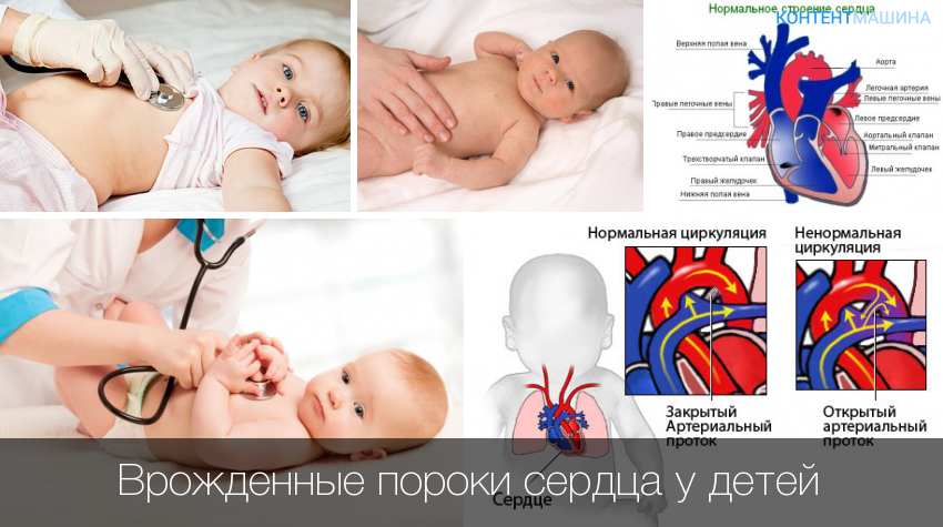 Как заботиться о сердце наших детей: врожденные аномалии сердца