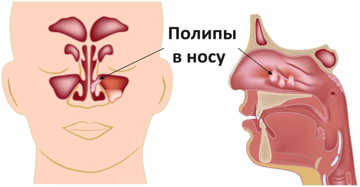 Полипы носа. симптомы, причины и лечение полипов носа без операции