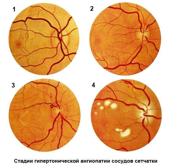 Ангиопатия сетчатки глаза у детей