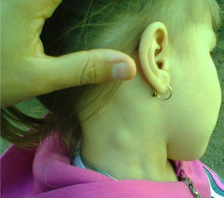 Шишка за ухом у малыша, причины ее развития, основные симптомы и способы лечения