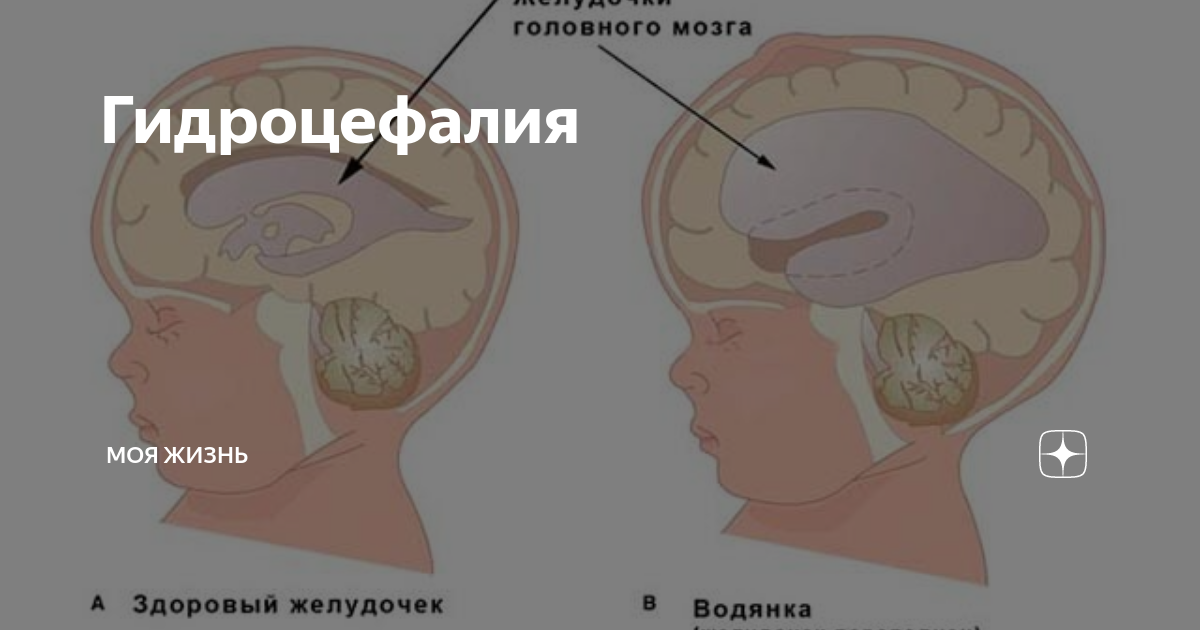 Внутриутробная гидроцефалия. Гидроцефалия головного мозга. Гидроцефалия головного мозга у ребенка.