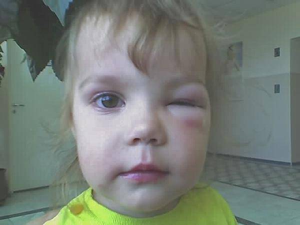 Ребенка укусила мошка в глаз - что делать и чем снять отек, если опухло веко