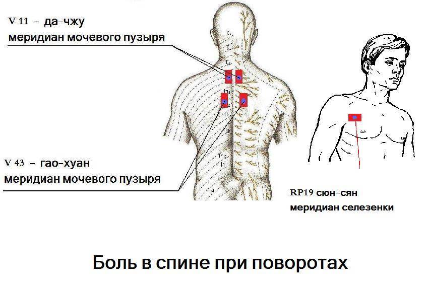 Защемило шею и больно поворачивать: что делать в домашних условиях?