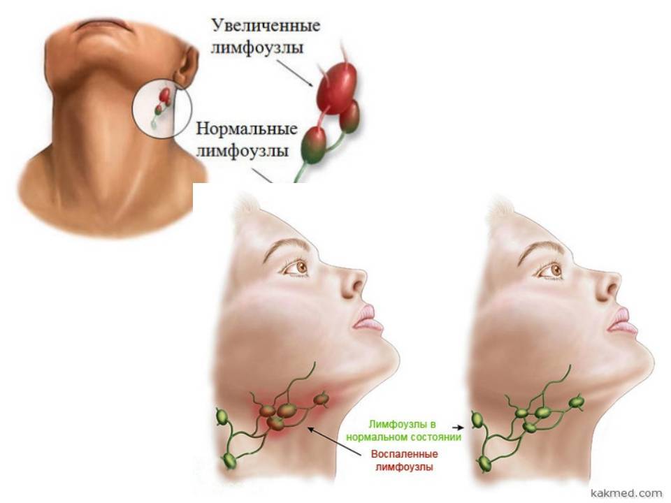 Увеличенные лимфоузлы – иммунный ответ организма. о чем он говорит?