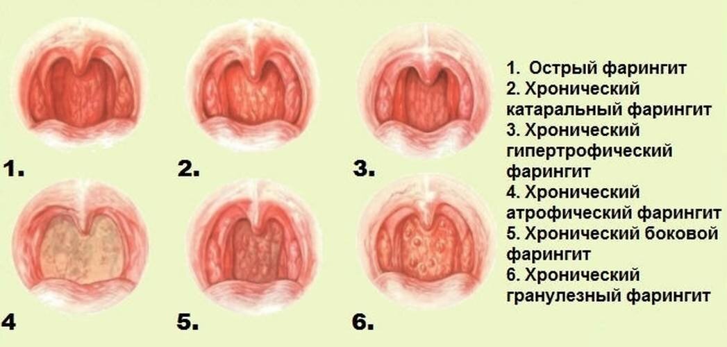 Фарингит симптомы у детей и взрослых, признаки и лечение заболевания.