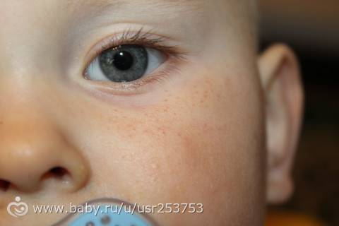 Причины возникновения красных кругов, точек или пятен под глазами у ребенка
