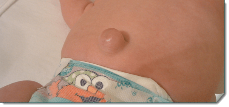 Фунгус пупка у новорожденных: почему появляется гранулема, методы обработки и лечения