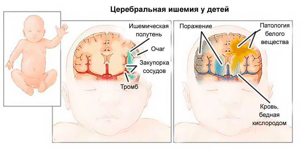 Субэпендимальная киста мозга у новорожденных детей: причины, опасна или нет?