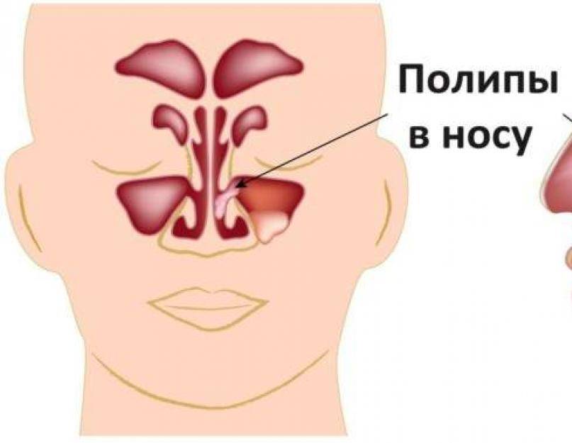 Заложенность носа у грудничка