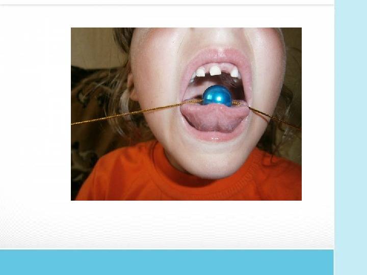 Уздечка верхней губы у детей: какой должна быть в норме, нужно ли подрезать?