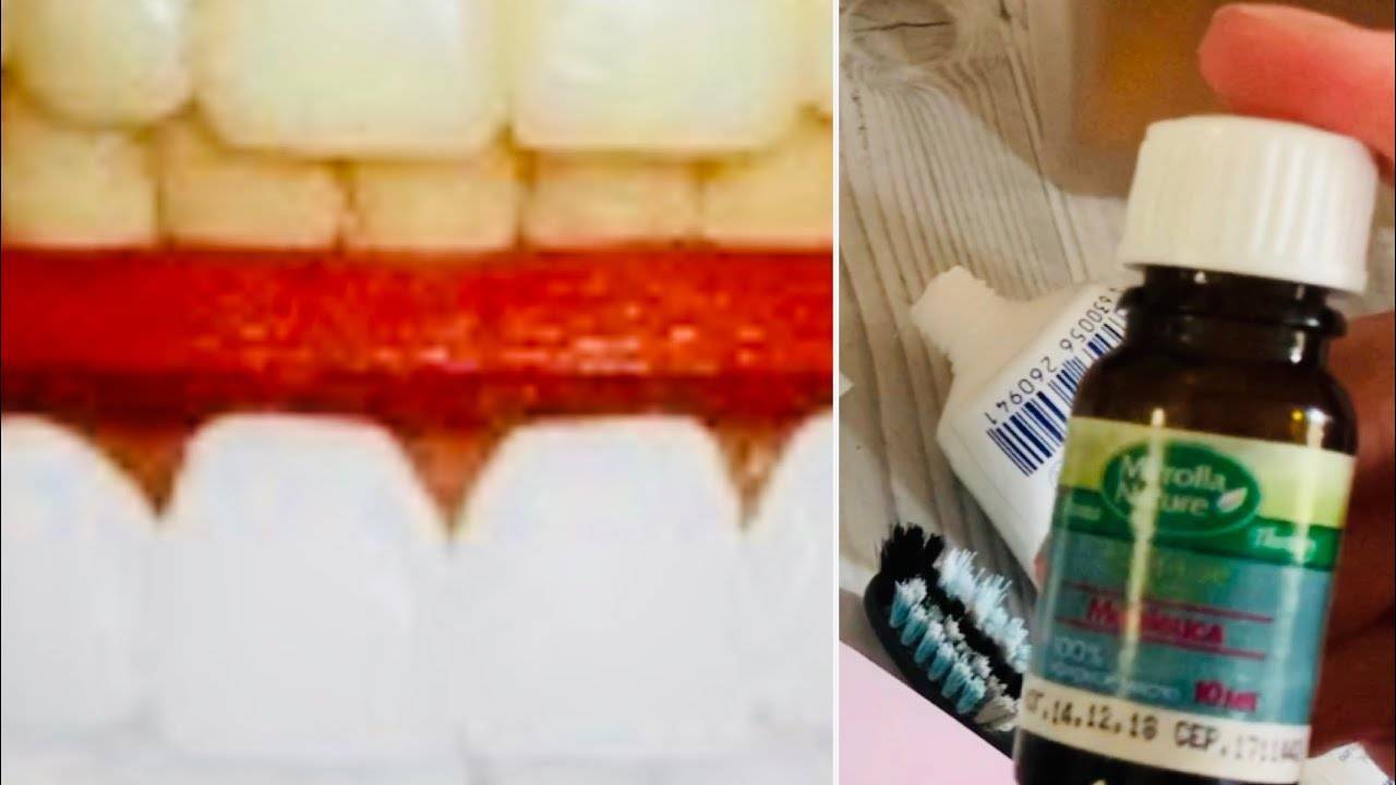 От стоматолога к гастроэнтерологу: налеты на зубах.