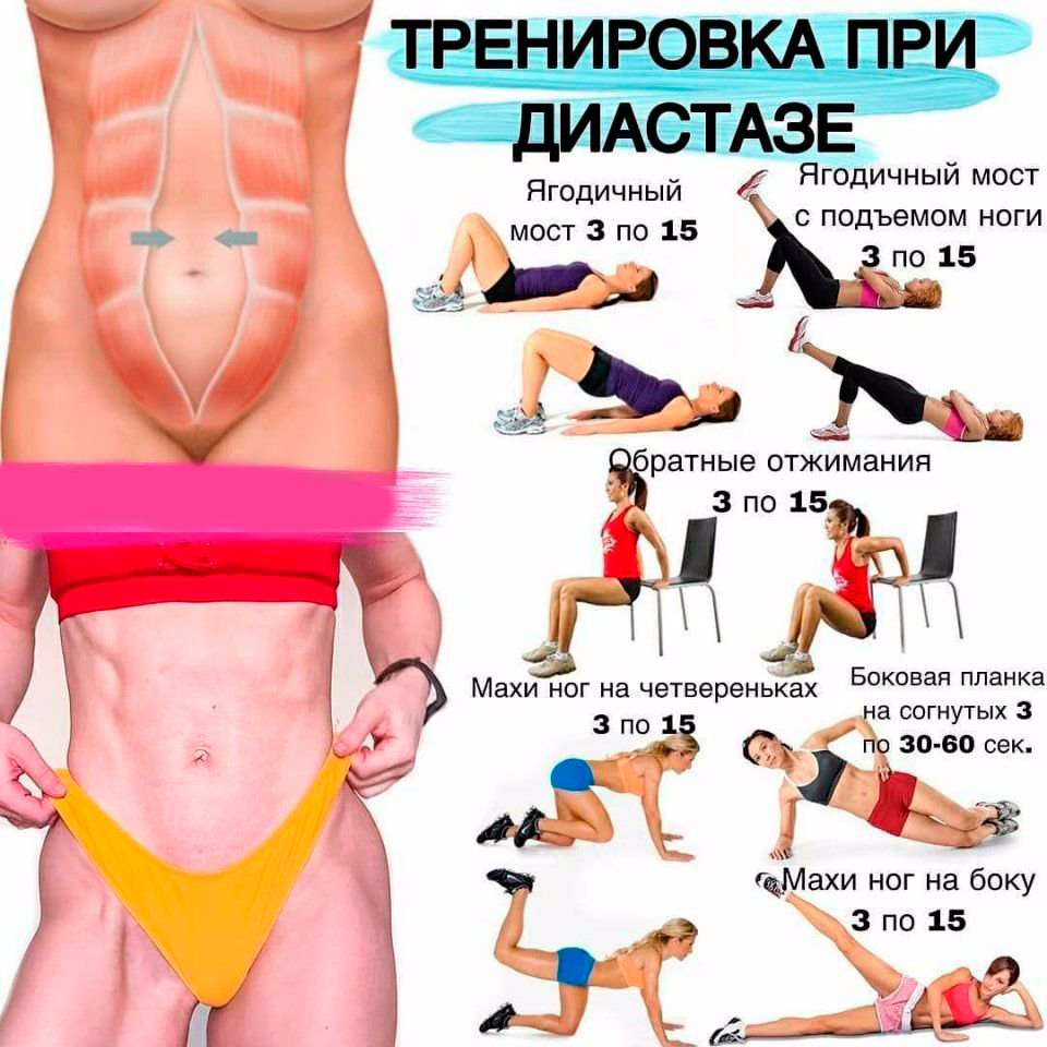 Диастаз после родов- что это и как с ним бороться | momslab