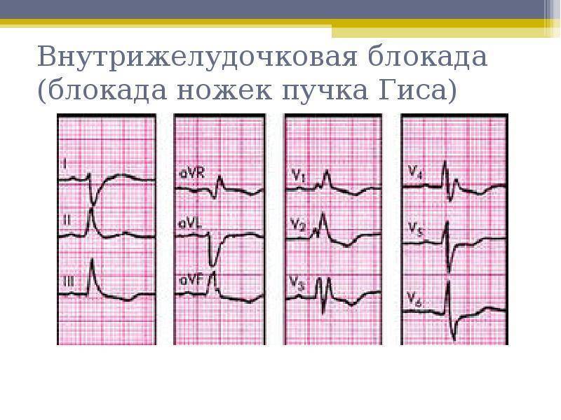 Неполная блокада правой ножки пучка гиса картинки