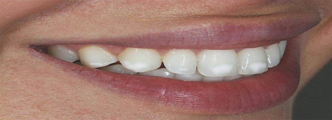 Черный налет на зубах: как удалить – стоматология президент