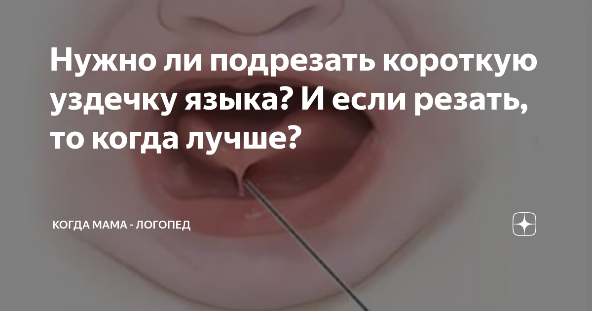 Как определить короткую уздечку языка у ребенка и нужно ли подрезать