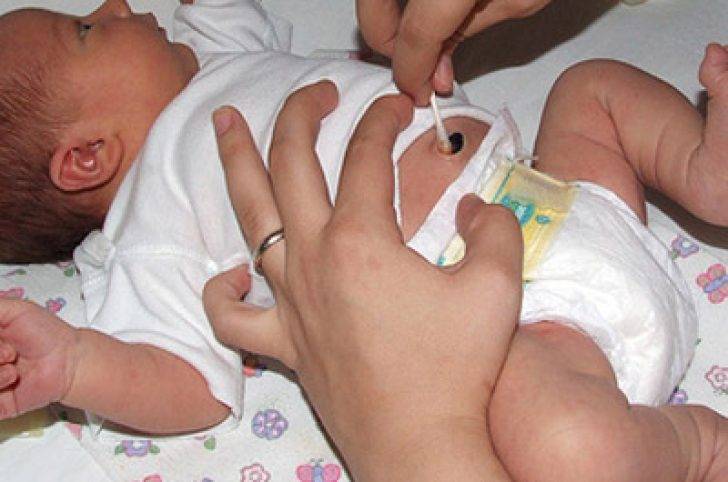 Фунгус пупка (гранулема) у новорожденных: причины, лечение и последствия