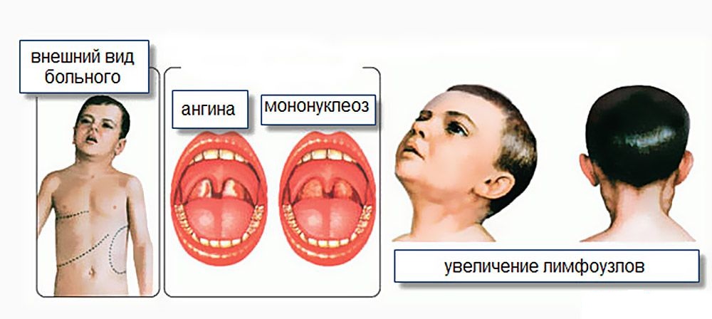 Инфекционный мононуклеоз у детей: виды, причины, симптомы, диагностика, лечение и профилактика + видео комаровского