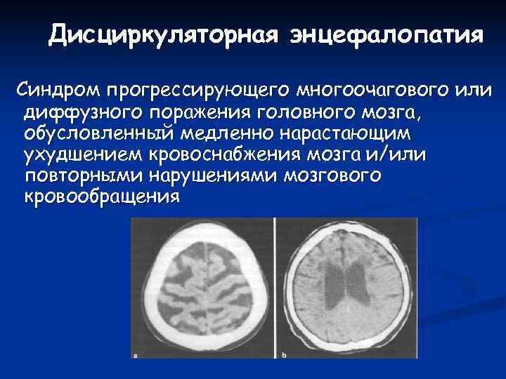 Кт признаки дисциркуляторной энцефалопатии. Дисциркуляторная энцефалопатия цефалгический синдром. Энцефалопатия головного мозга на кт. Единичное очаговое изменение дисциркуляторного характера