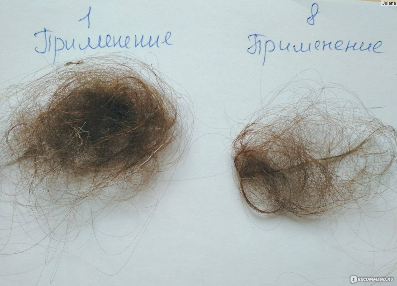 Выпадают волосы при беременности на ранних и поздних сроках: причины и лечение