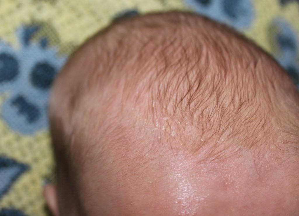 Распространенные заболевания кожи головы: дерматологические, грибковые, гнойничковые, инфекционные
