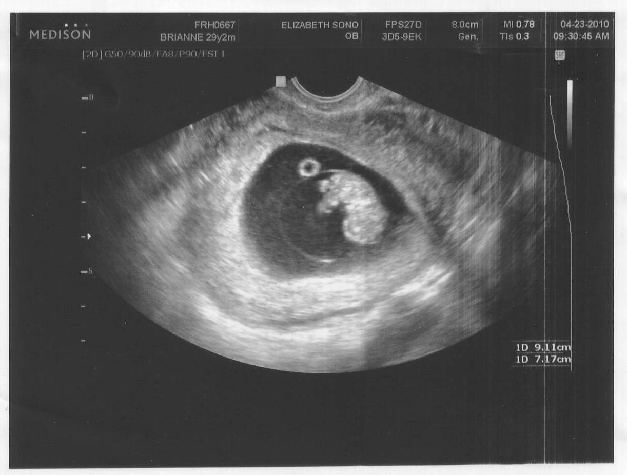 Беременна или нет? узи покажет, куда делся эмбрион