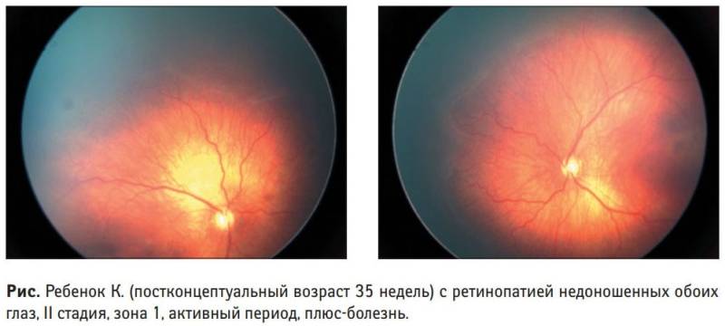 Ретинопатия недоношенных - симптомы болезни, профилактика и лечение ретинопатии недоношенных, причины заболевания и его диагностика на eurolab