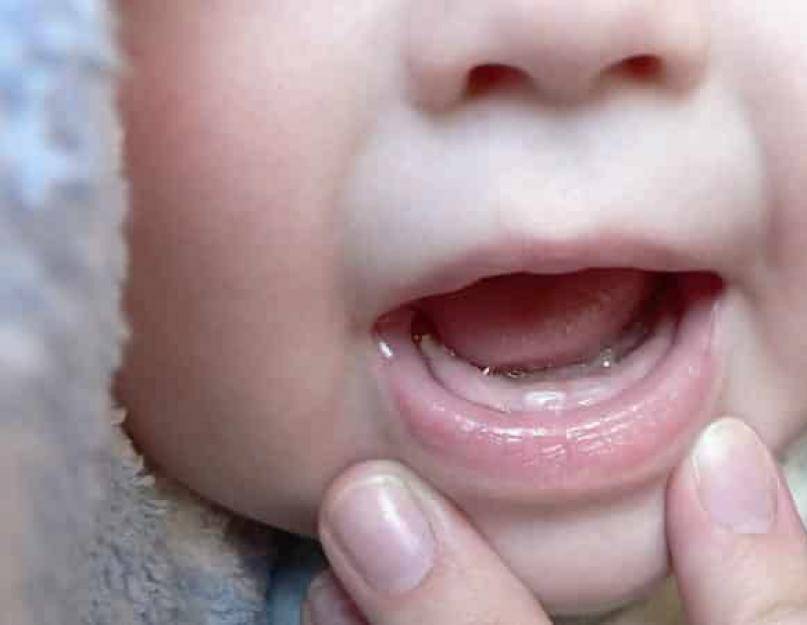 Эпулис на десне: лечить или удалять – статьи стоматологической клиники «доктор мартин»
