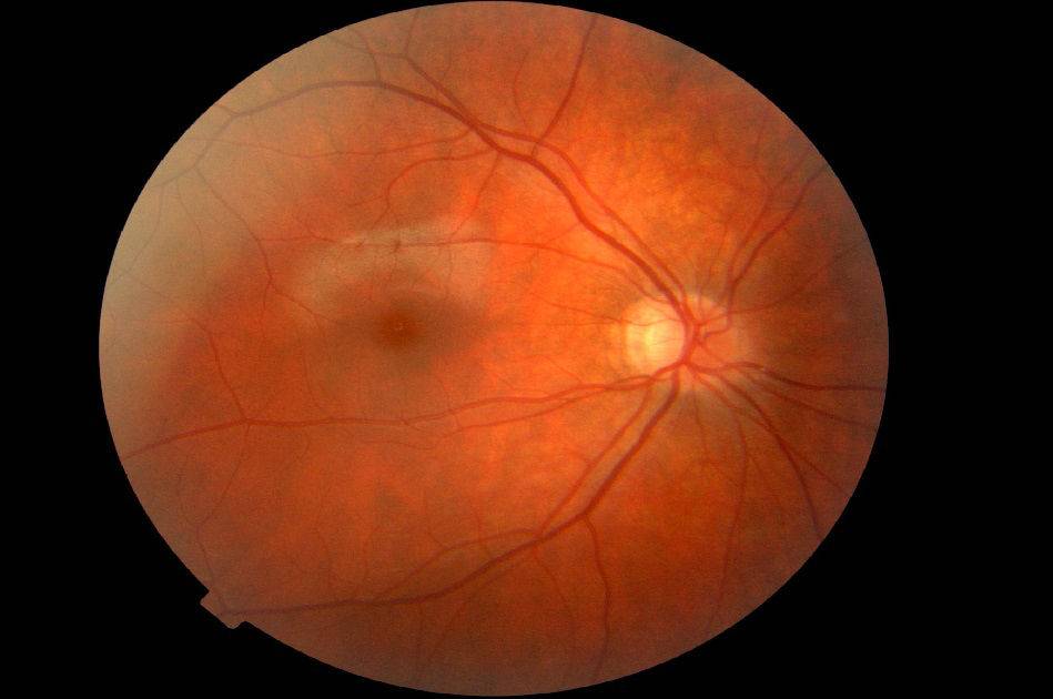 Ангиопатия сетчатки глаза у ребенка - что это, лечение, причины, симптомы | все о болезнях глаз