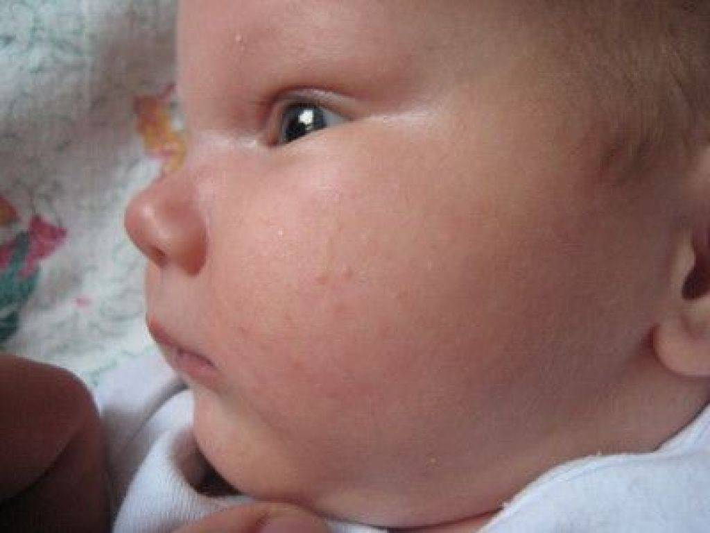 Акне на лице у новорожденных — причины появления, первые симптомы, профилактика