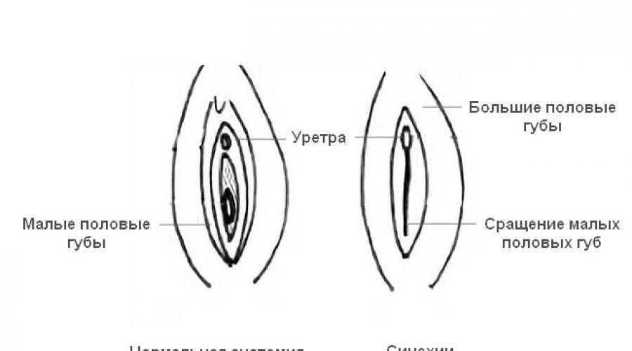 Маленький нормально. Сращения малых половых губ девушек. Синехии малых и больших половых губ. Сращение малых половых губ (синехия).