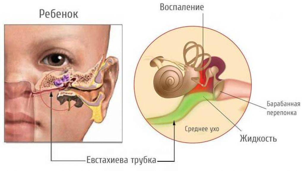 Отит у ребенка картинки