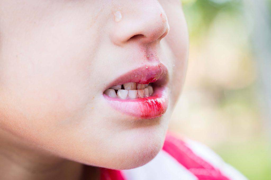 Ребенок разбил губу и изнутри она опухла — что делать и чем обработать рану, как лечить уздечку верхней губы если она порвалась