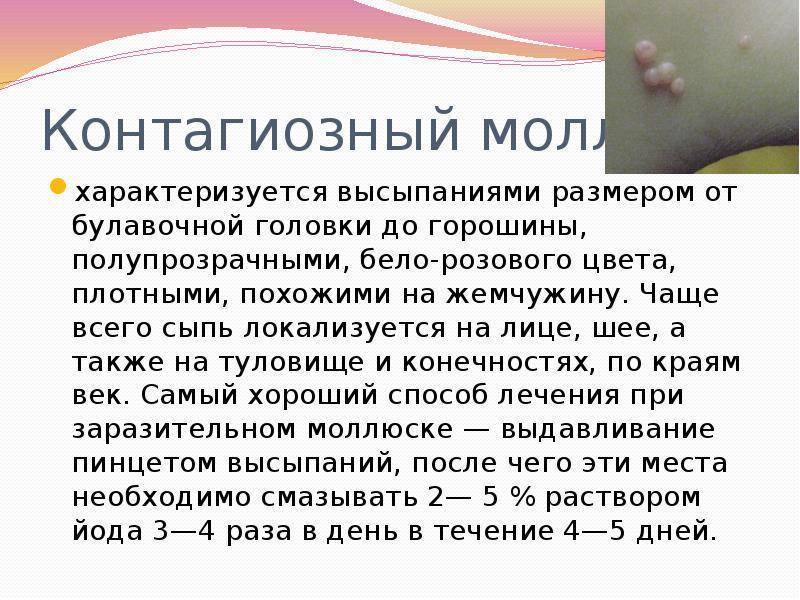 Контагиозный моллюск фото у детей