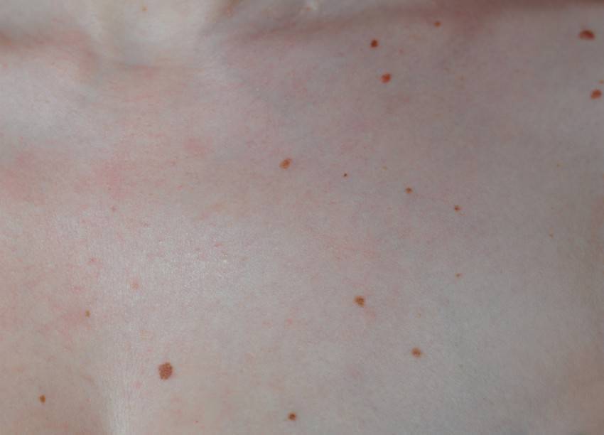 О каких заболеваниях говорит кожная сыпь