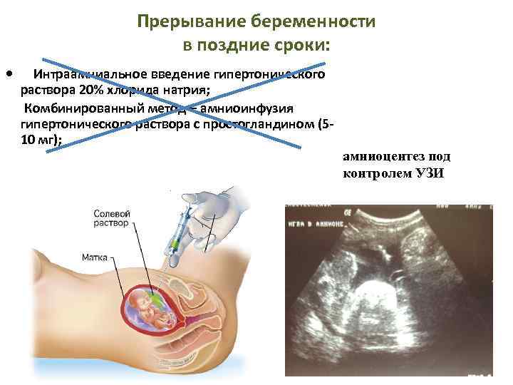Вероятность забеременеть после медикаментозного аборта