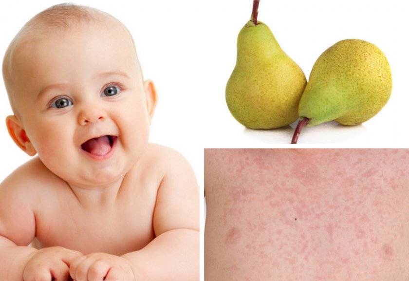 Пищевая аллергия в детском возрасте